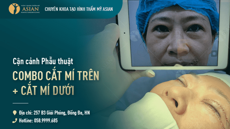 Cắt mí mắt dưới