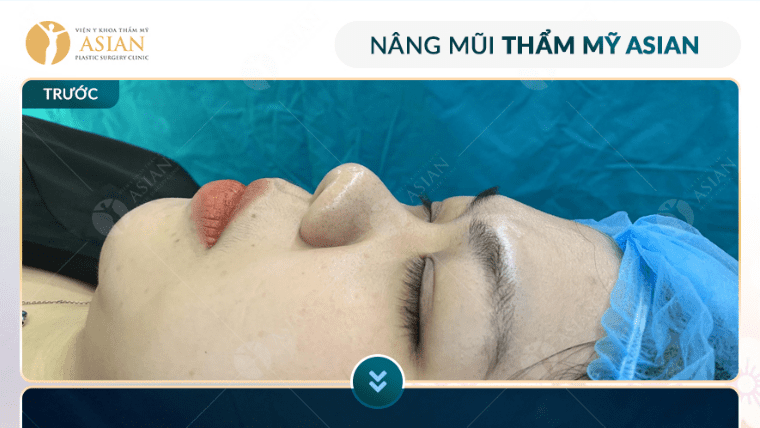Nâng mũi bọc sụn tai (cần content)